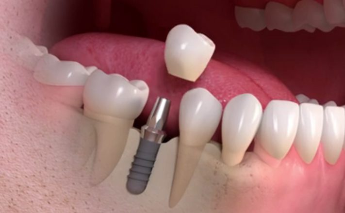 Dental-Ipmlant-Placement.jpg