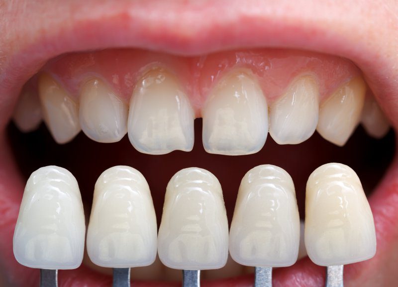 Dental-Veneers.jpg