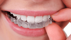 Invisalign-FeaturedImage.png