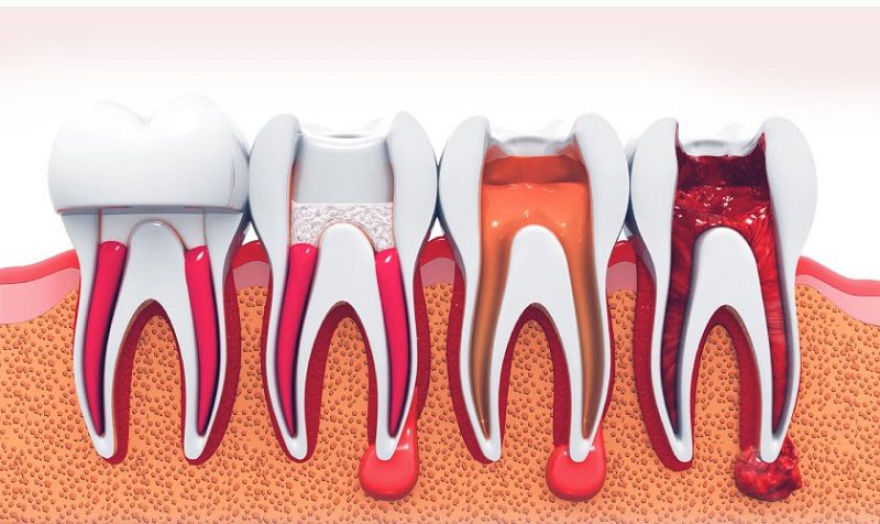 Root-Canal-Therapy-1.jpg