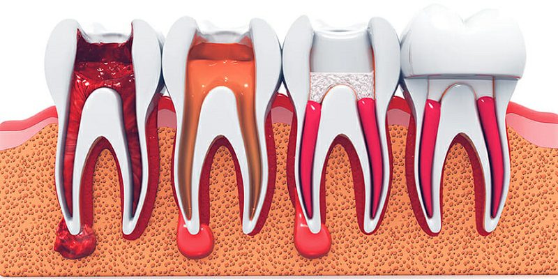 Stages-for-Root-Canal.jpg