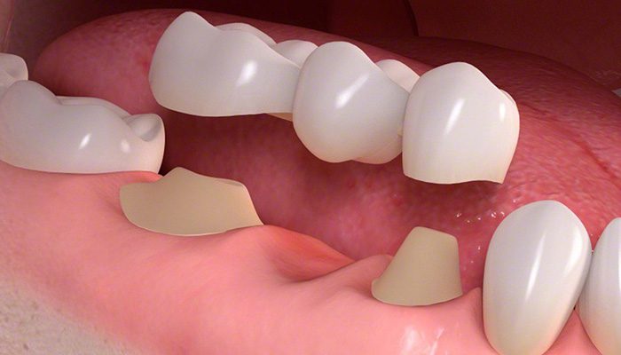 dental_bridge_sm.jpg