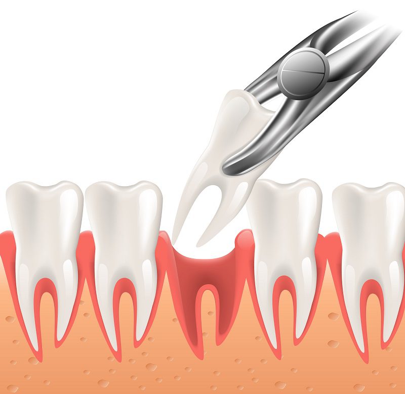 extracting-wisdom-teeth-may-prevent-problems-later.jpg