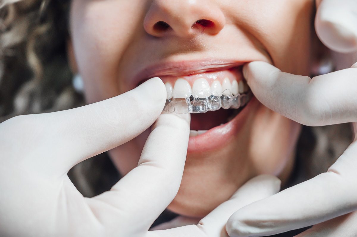 invisalign.jpg