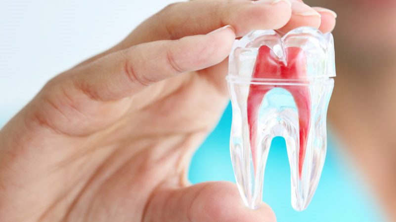 root-canal-1.jpg