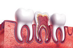 root-canal20176.jpg