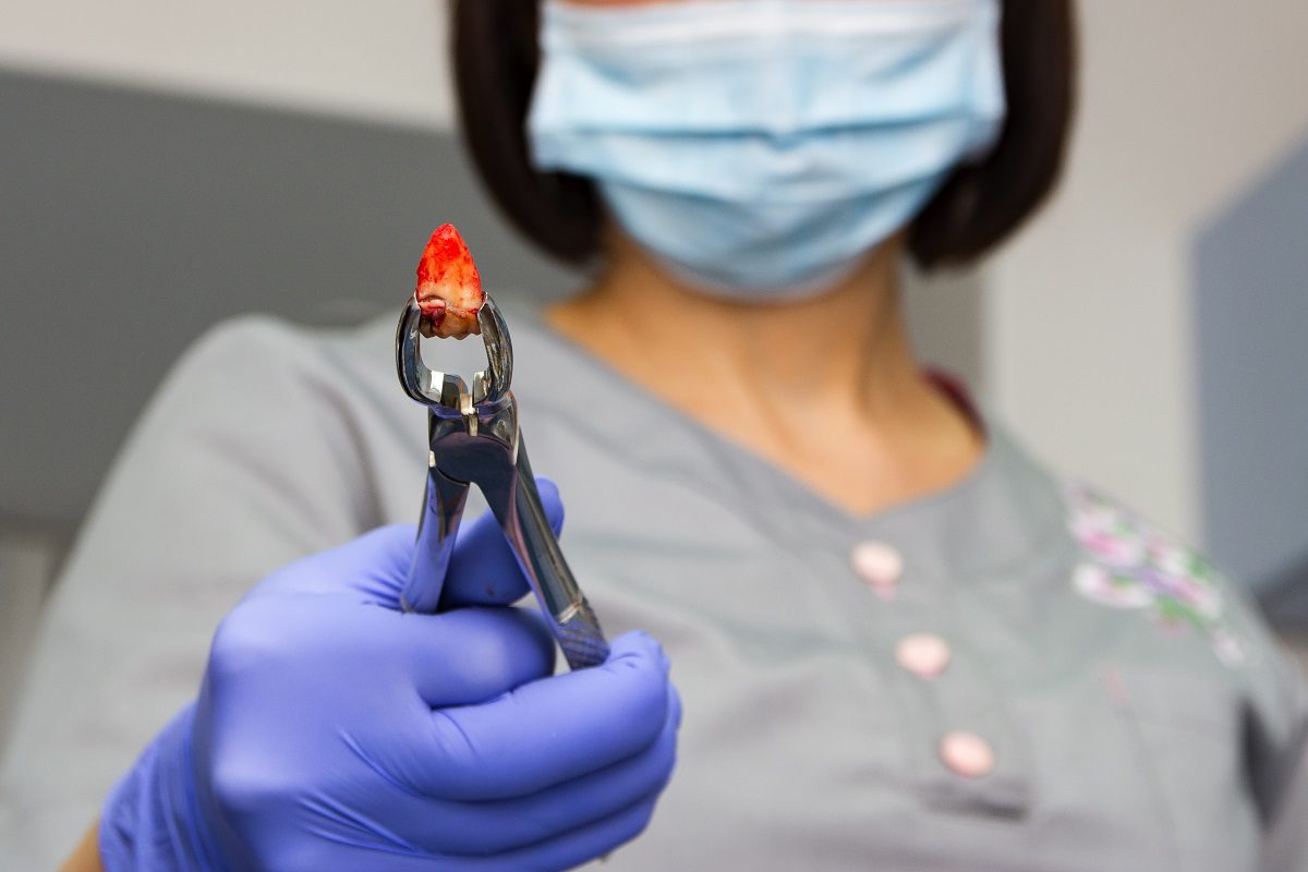 tooth-extraction-2.jpg