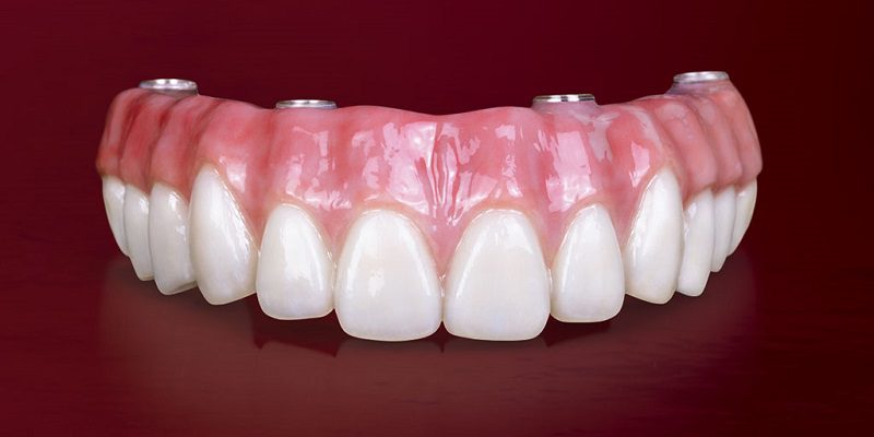 tw-featured-bruxzir-full-arch-implant-prosthesis.jpg